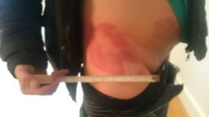Person showing a large red bruise or rash on their side, with a measuring tape held horizontally across the area—an...