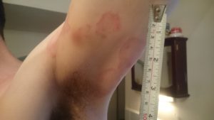 A person’s armpit with several red, circular rash marks—possibly stress related—measured at 4–5 cm in diameter. The...