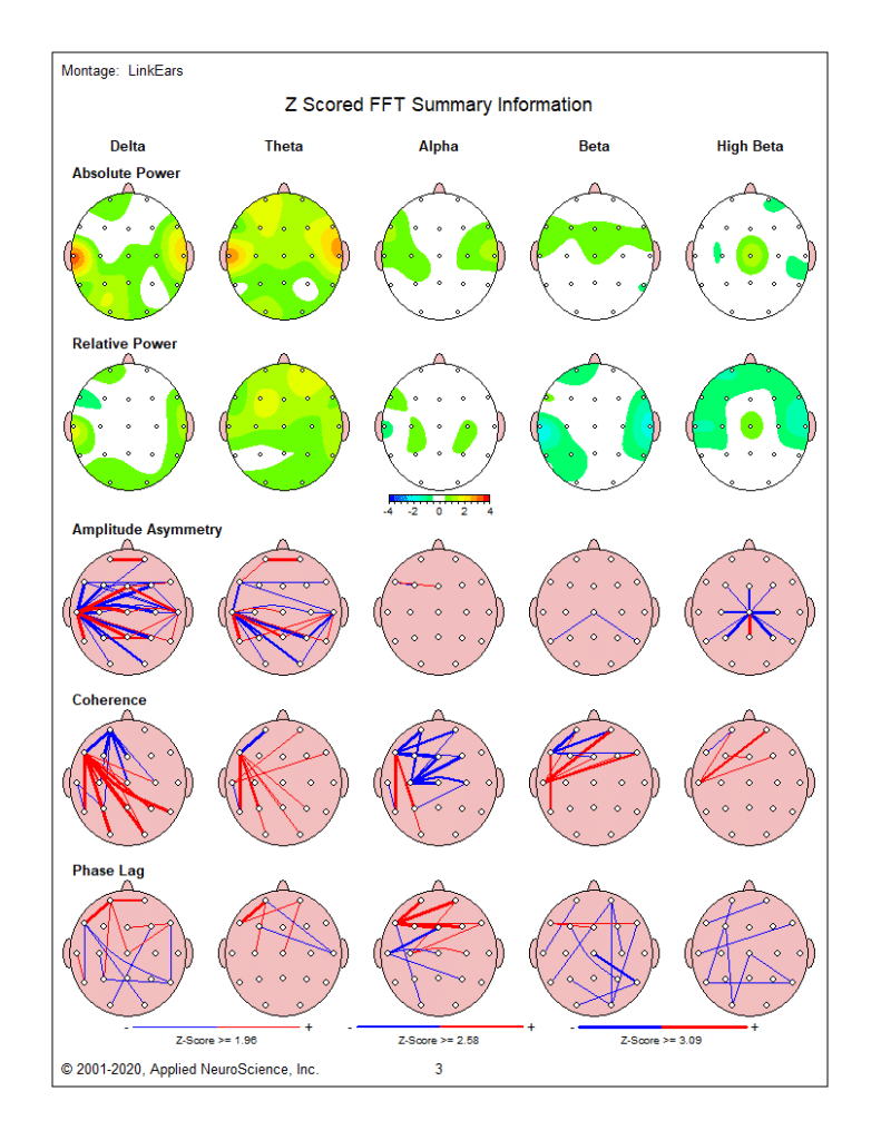 A grid of brain activity maps shows Z scored FFT summaries for delta, theta, alpha, beta, and high beta bands in...