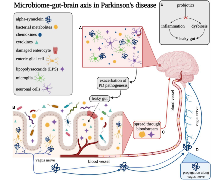 Diagram showing how gut microbiome imbalance and gut inflammation contribute to Parkinson’s disease. It illustrates gut...